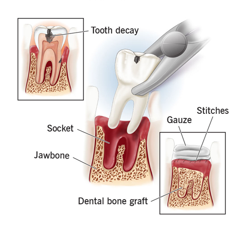 Why Choose Aurora Smiles For Your Tooth Extraction 02