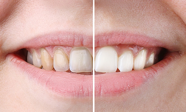 DIY Teeth Whitening vs. Professional Services